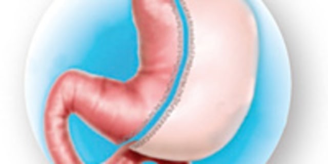 illustration of inset procedure sleeve gastrectomy