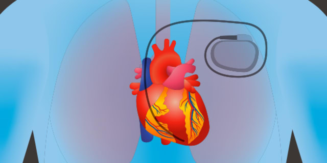 illustration of heart pacemaker