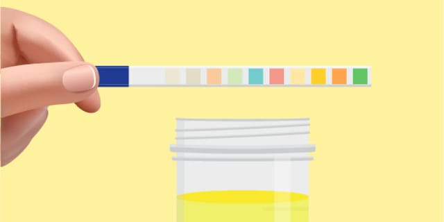 A dipstick measures urine coloring