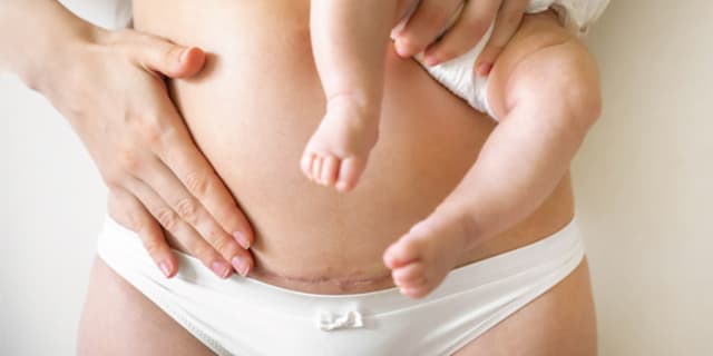 photo for C-section misconceptions article