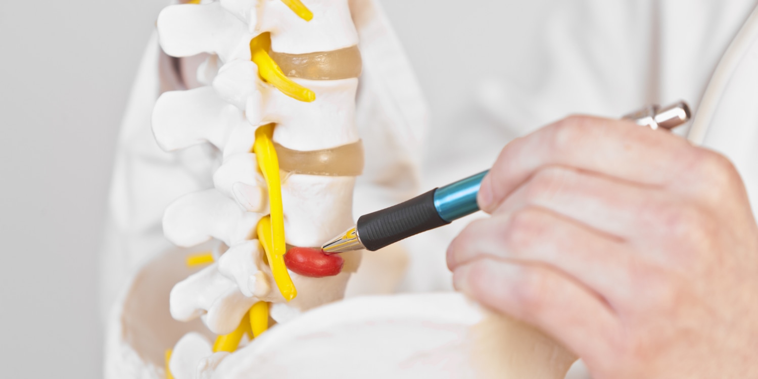 Doctor holding model of portion of lumbar spine points out herniated disc