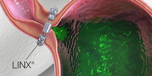 illustration of linx reflux management system procedure
