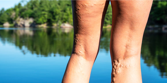 close up of varicose veins on a woman's legs