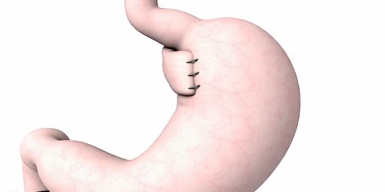 illustration of the stomach organ with the fundoplication procedure done