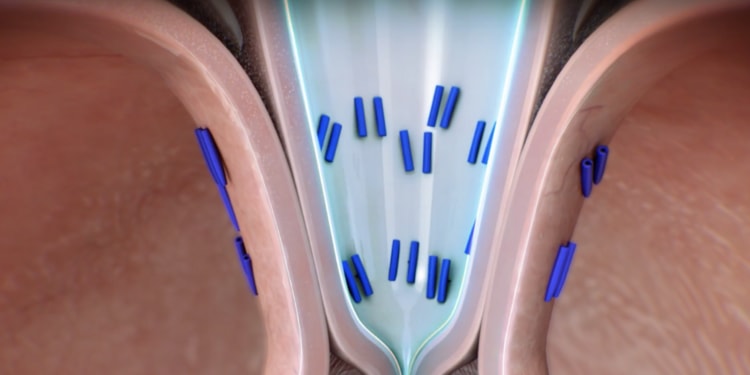 illustration of TIF procedure for reflux treatment