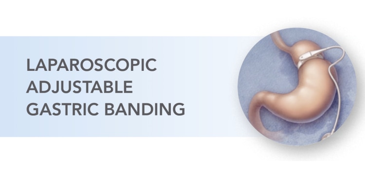illustration of laparoscopic adjustable gastric banding