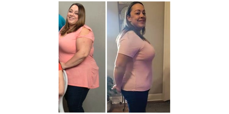 Bariatrics patient Lane, before and after weight loss surgery