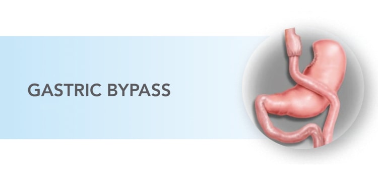 illustration of gastric bypass procedure