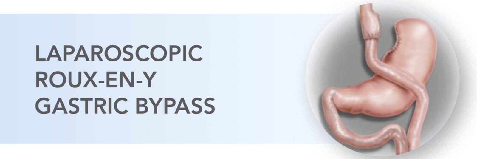 illustration of laparoscopic roux-en-y gasric bypass