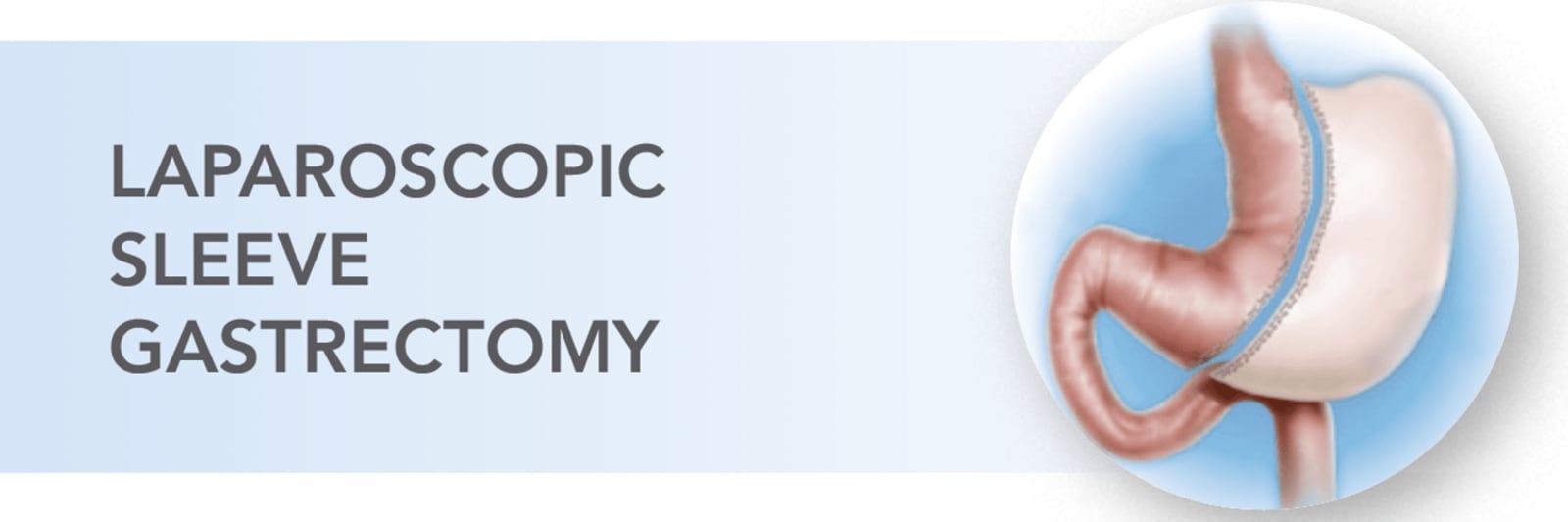 illustration of laparoscopic sleeve gastrectomy