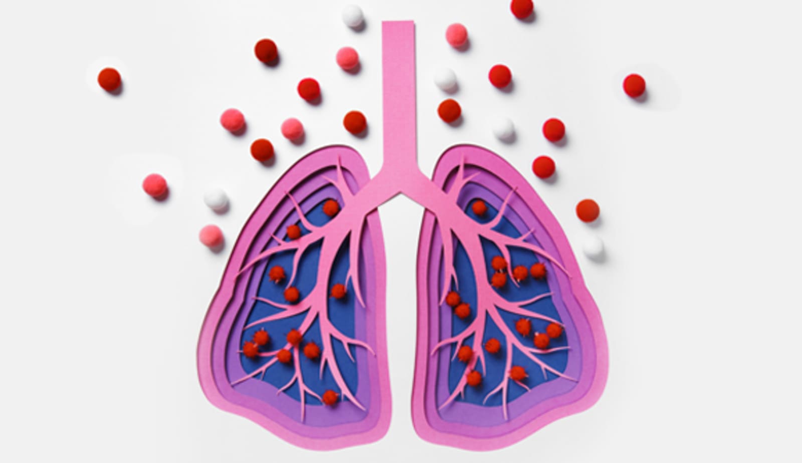 Graphic representation of a lung with pneumonia 