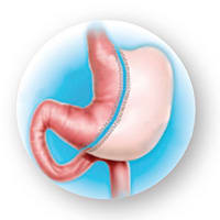 illustration of inset procedure sleeve gastrectomy