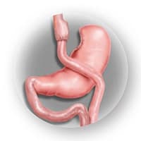 illustration of gastric bypass procedure