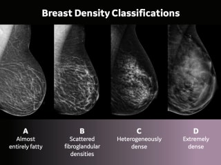 breast density classifications