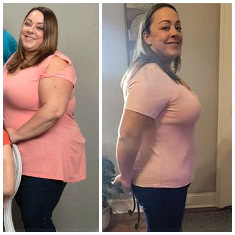 Bariatrics patient Lane, before and after weight loss surgery