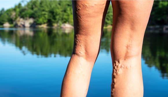 close up of varicose veins on a woman's legs