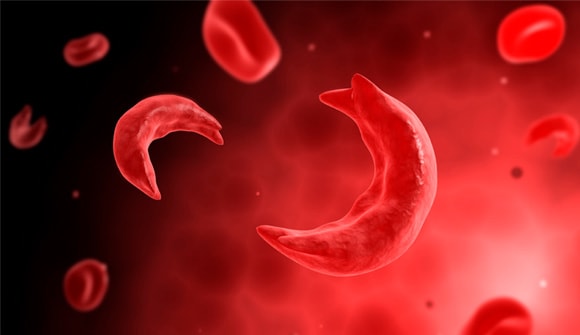 Sickle cell blood shapes