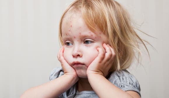 photo for Worried about measles? article