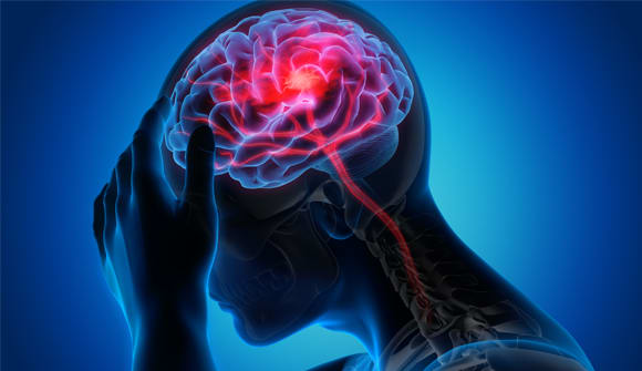 illustration of the human brain to demonstrate a stroke