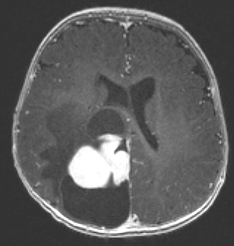 scan of a baby's brain showing a large tumor