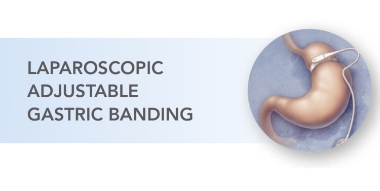 illustration of laparoscopic adjustable gastric banding