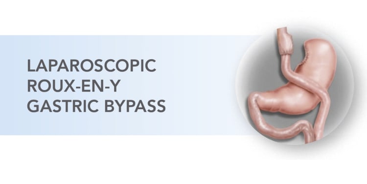 illustration of laparoscopic roux-en-y gasric bypass