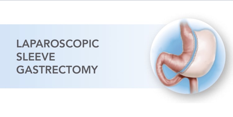 illustration of laparoscopic sleeve gastrectomy