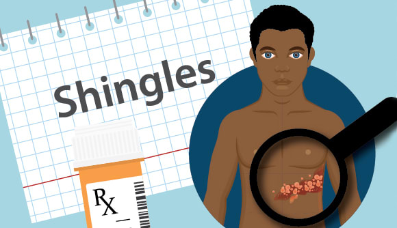 A graphic showing shingles rash on an adult patient