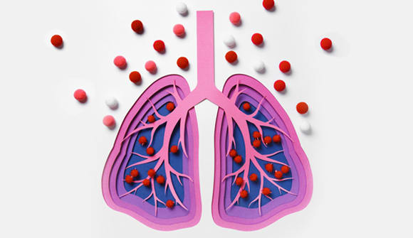 Graphic representation of a lung with pneumonia 