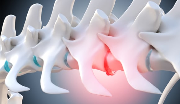 illustration of injured spinal disk causing back pain