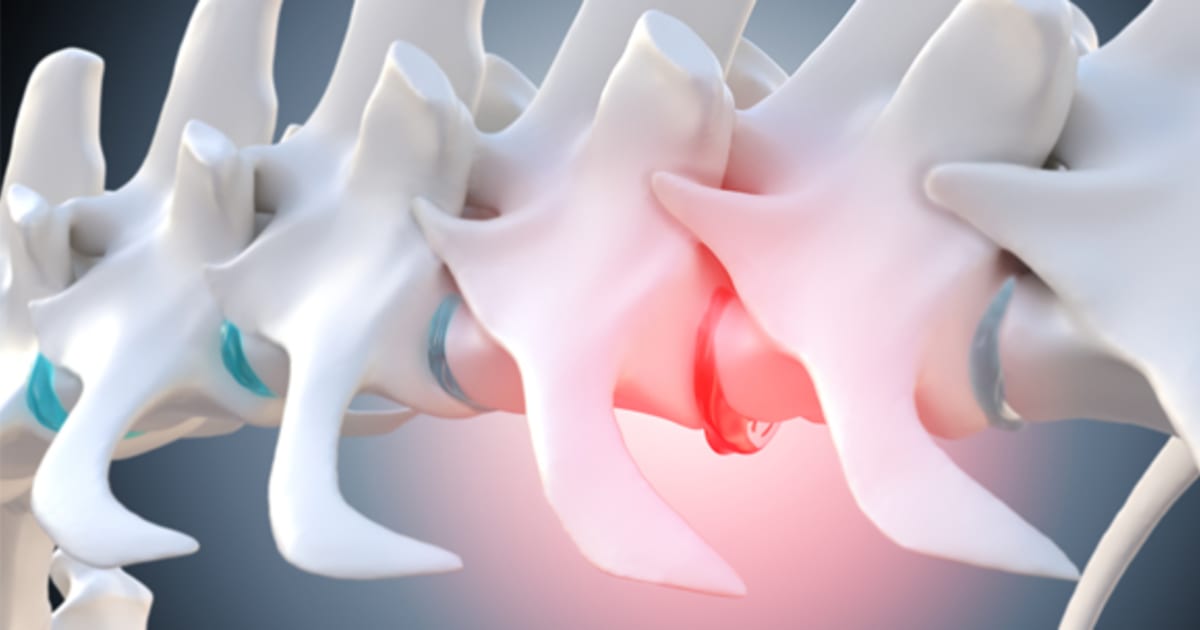 Disc Injuries Back Back pain relief: treating disk injuries | Baptist Health