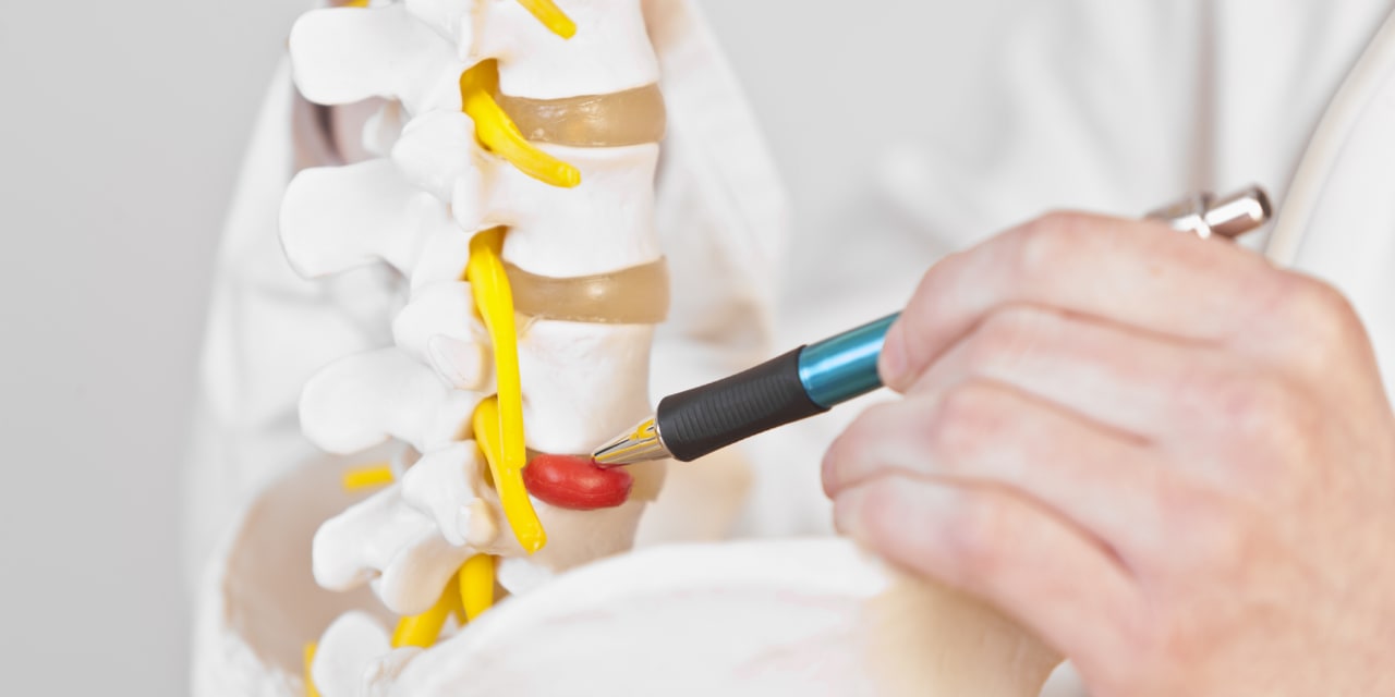 Doctor holding model of portion of lumbar spine points out herniated disc