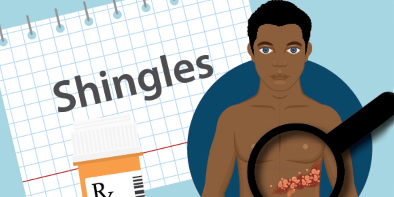 A graphic showing shingles rash on an adult patient