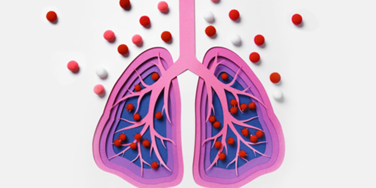 Graphic representation of a lung with pneumonia 
