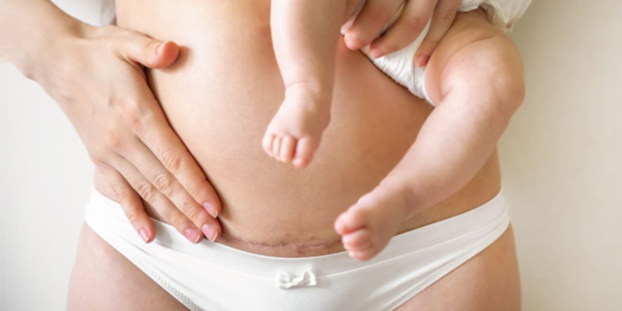photo for C-section misconceptions article