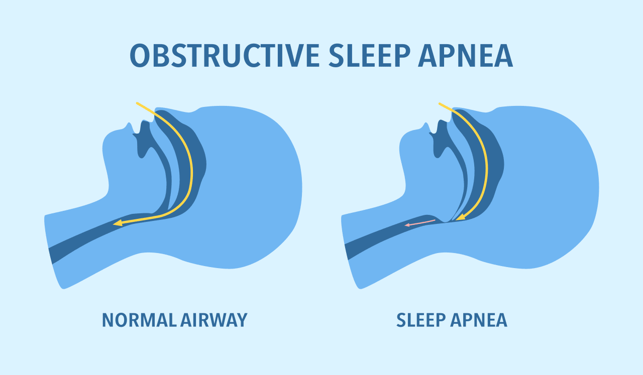 obstructive sleep apnea graphic