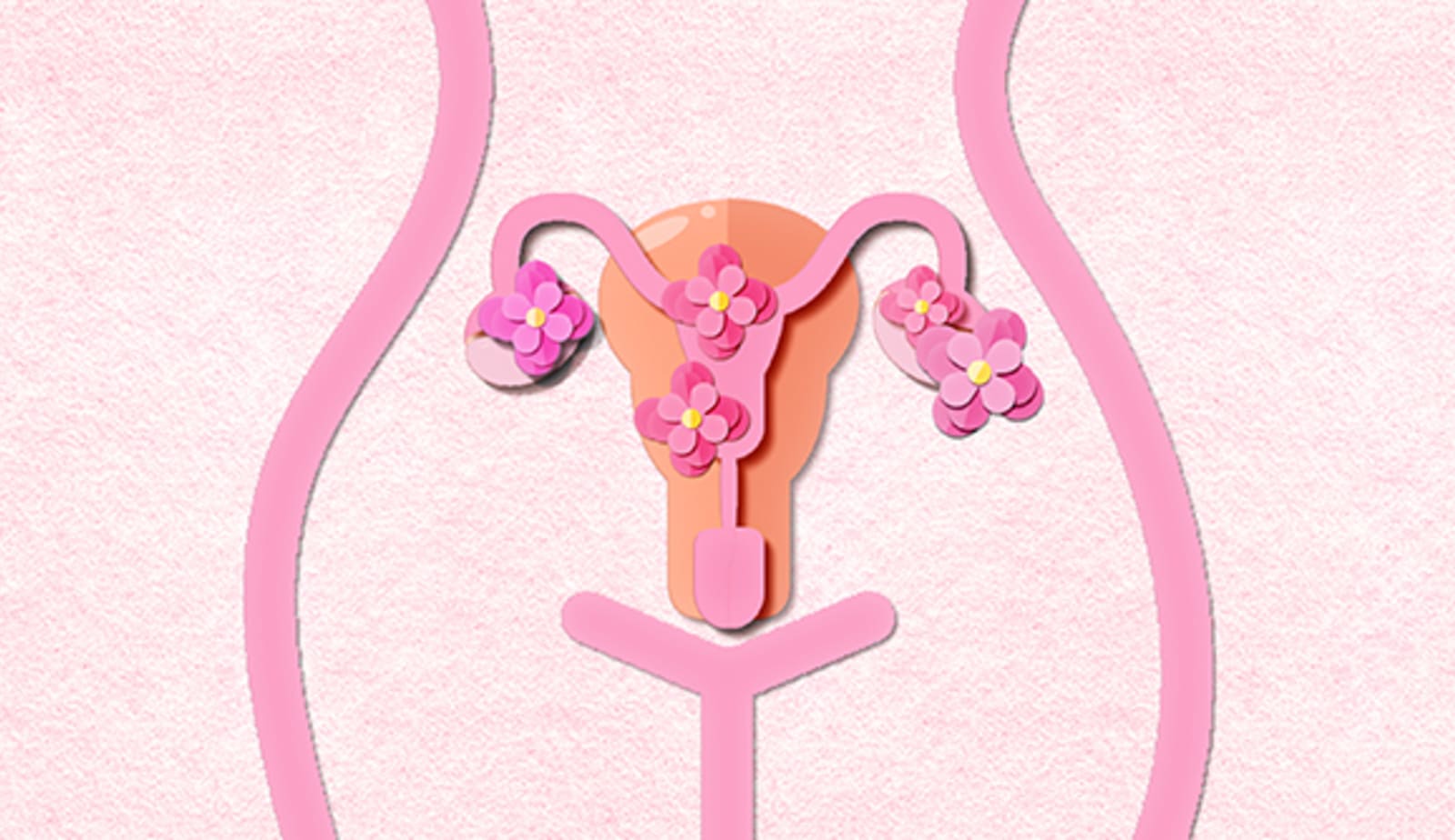 paper cut out depicting polycystic ovary syndrome