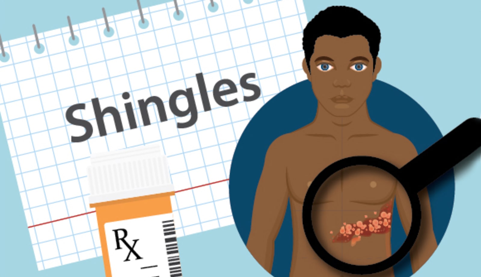 A graphic showing shingles rash on an adult patient