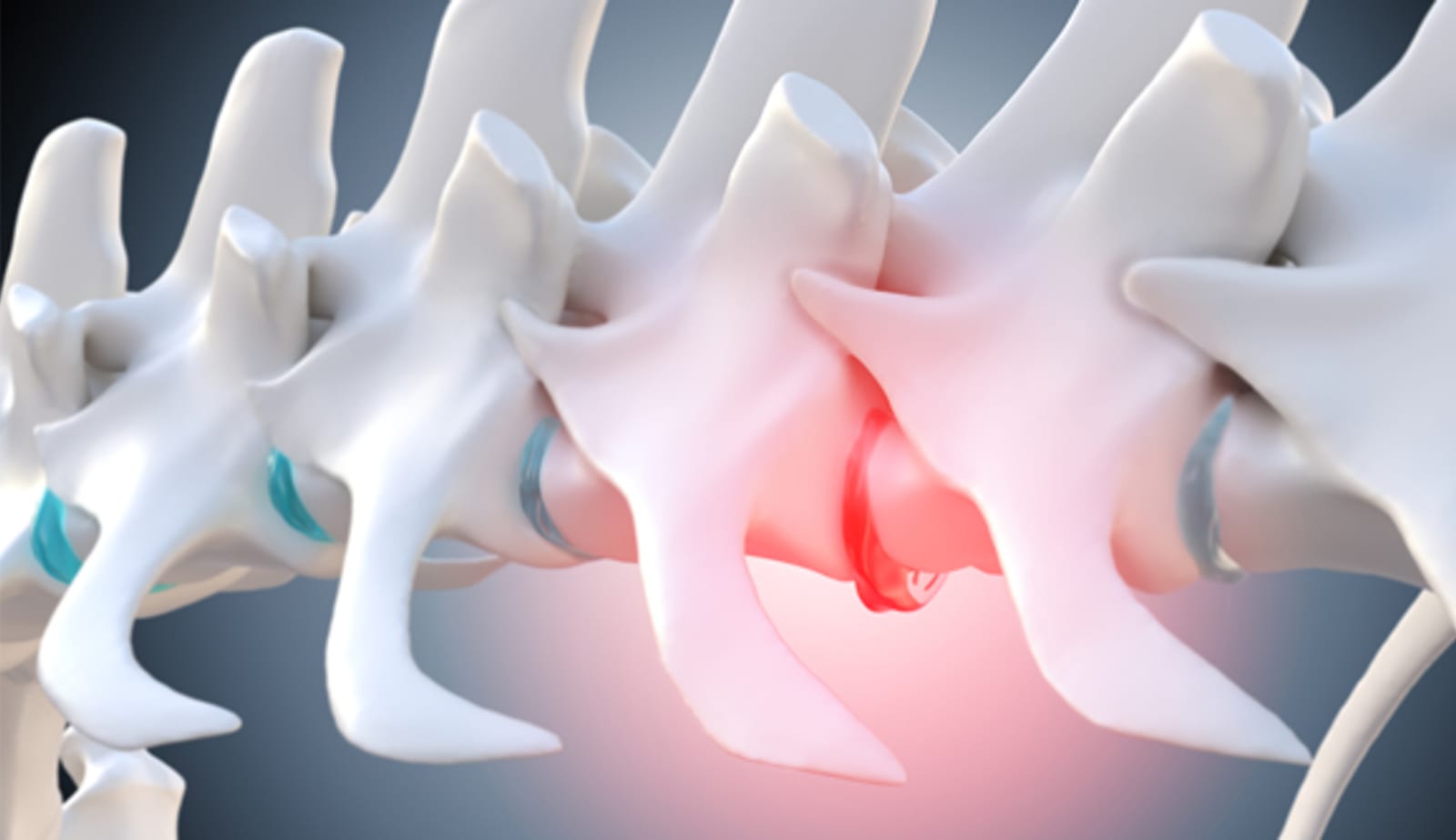 illustration of injured spinal disk causing back pain