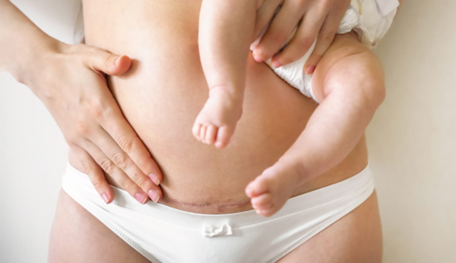 photo for C-section misconceptions article