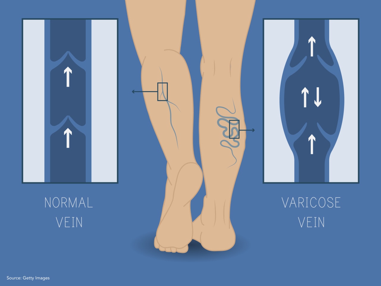 illustration of a varicose vein vs. a regular vein